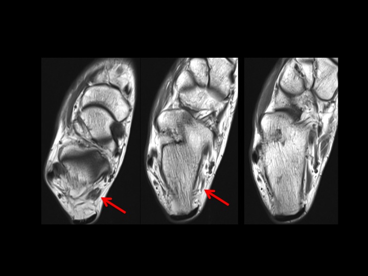 Figure 2 for case accessory flexor muscle